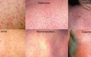 Ребенок покрылся красными пятнами: фото с описанием сыпи, возможные причины, способы лечения, профилактика