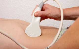 Стент в урологии как он выглядит