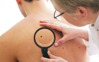 Убрать черные точки на носу. Как убрать черные точки на носу у подростка в домашних условиях