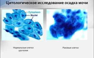 Урология кровь в мочевом пузыре