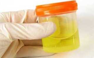 Причины плохого анализа мочи у грудничка