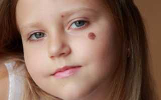 Родинки на теле: причины появления и удаление у детей и взрослых