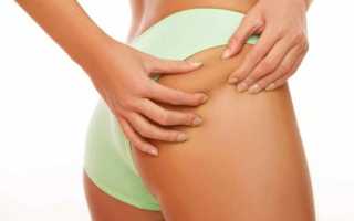 Как лечить фурункул или чирей на попе (ягодице), фото