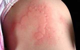 Лечение хронической крапивницы (идиопатической рецидивирующей), а также фото, причины и симптомы