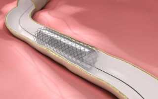 Как ставят стенд при камнях в почках?