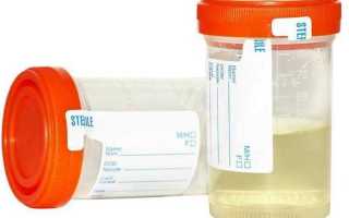 Повышенные лейкоциты в моче у женщин: причины и диагностика