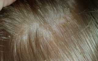 Корка на голове — причины возникновения и лечение медикаментозными, косметическими и народными средствами