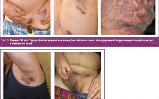 Перифолликулит Гофмана: особенности болезни, ее причины, симптомы, методы диагностики и лечения