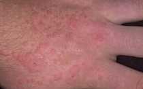 Признаки макулопапулезной сыпи и методы лечения