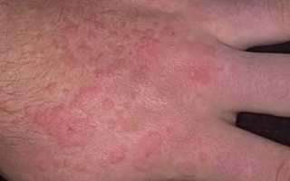 Признаки макулопапулезной сыпи и методы лечения