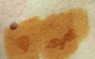 Как и в каком случае можно определить лишай с помощью йода