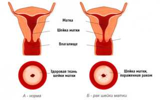 Что такое бовеноидный папулез: клинические признаки и эффективные способы лечения