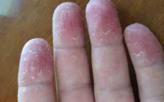 Почему у ребёнка может облазить кожа на пальцах рук и что с этим делать