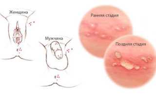 Герпес или обычный прыщ — как понять с чем бороться?