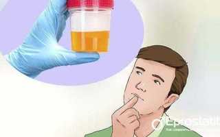 Мутная моча и осадок в моче у мужчины