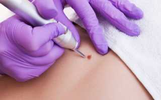 Что делать при появлении папиллом в области живота?