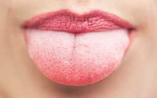 Наросты на языке: безобидные папилломы или раковая опухоль?