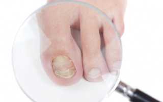 Как лечить грибок ногтей пищевой содой в домашних условиях