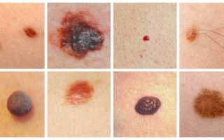 От чего появляются родинки — причины возникновения у человека. Почему появляются родинки на теле, видео