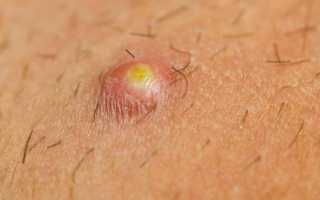 Абсцесс мягких тканей: первые признаки, описание с фото, лечение и профилактика