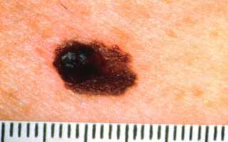 Изменения вокруг родинки (белое пятно, покраснение, ореол).