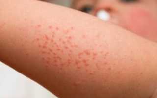 Где может появиться экзема у детей и как она выглядит?