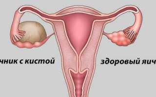 Что делать если лопнула киста яичника