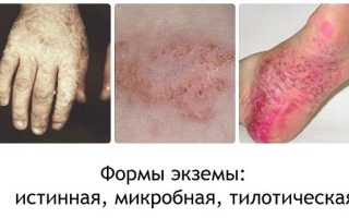 Чем лечить экзему на руках: лечение мазями, препаратами, народными средствами