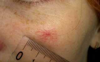 Кровяный прыщи на коже: причины и лечение в домашних условиях