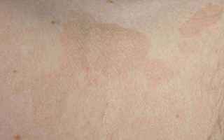 Лечение разноцветного лишая у человека: препараты и спреи