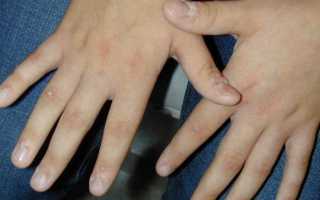 Бородавки на пальцах рук как избавиться в домашних условиях