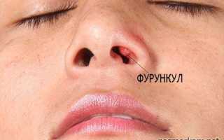 Чирей (фурункул) в носу: методы лечения, фото нарыва