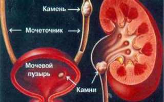 Как вывести камень в мочеточнике в домашних условиях : симптомы и лечение