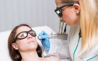 Удаление бородавок лазером или азотом: что лучше, где сделать, последствия, отзывы