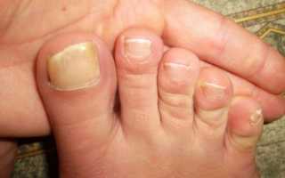 Выбор и особенности применения мазей для лечения грибка у детей