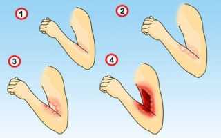 Первая помощь при лучевых ожогах — алгоритм действий