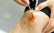 Что делать если из раны течет прозрачная жидкость, лимфа, сукровица