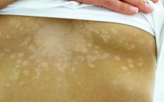 Разновидности белого лишая и лечение пятен у ребёнка