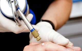 Как происходит удаление шипицы жидким азотом: процедура и уход