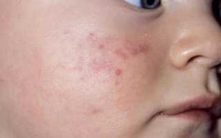 У малыша красные щечки и подбородок. У ребёнка красные щёки