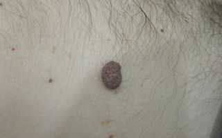 Почему из родинки растут волосы и можно ли их выщипать?