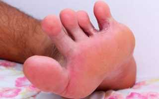 Как справиться с опрелостью между пальцами ног, рассмотрим лечение данной проблемы