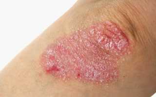 Что провоцирует обострение псориаза и как облегчить состояние?