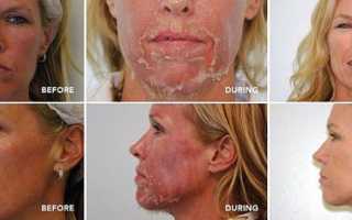 Осложнения после пилинга — чего ожидать от процедуры, а чего опасаться