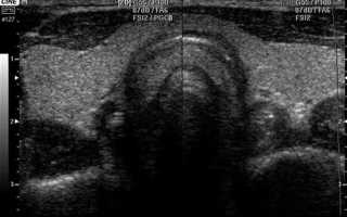 Урология удаление аденомы простаты