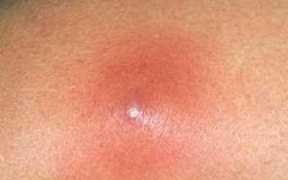 Болезненная липома: почему так происходит и что с этим делать