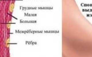 Почему возникла папиллома на груди? Эффективные методы лечения бородавок на молочных железах