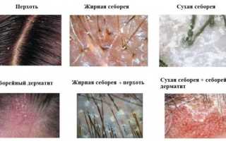 Салициловая кислота от прыщей. Как пользоваться чтобы не вызвать ожог, помогает ли в таблетках, рецепт болтушки с левомицетином. Показания и противопоказания