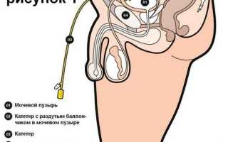 Замена катетера Фолея на дому в СПб