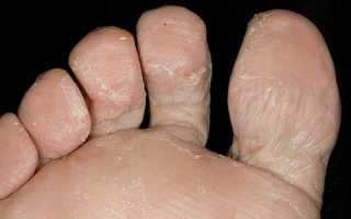 Почему шелушатся пятки и что делать, если облазит кожа на стопах?